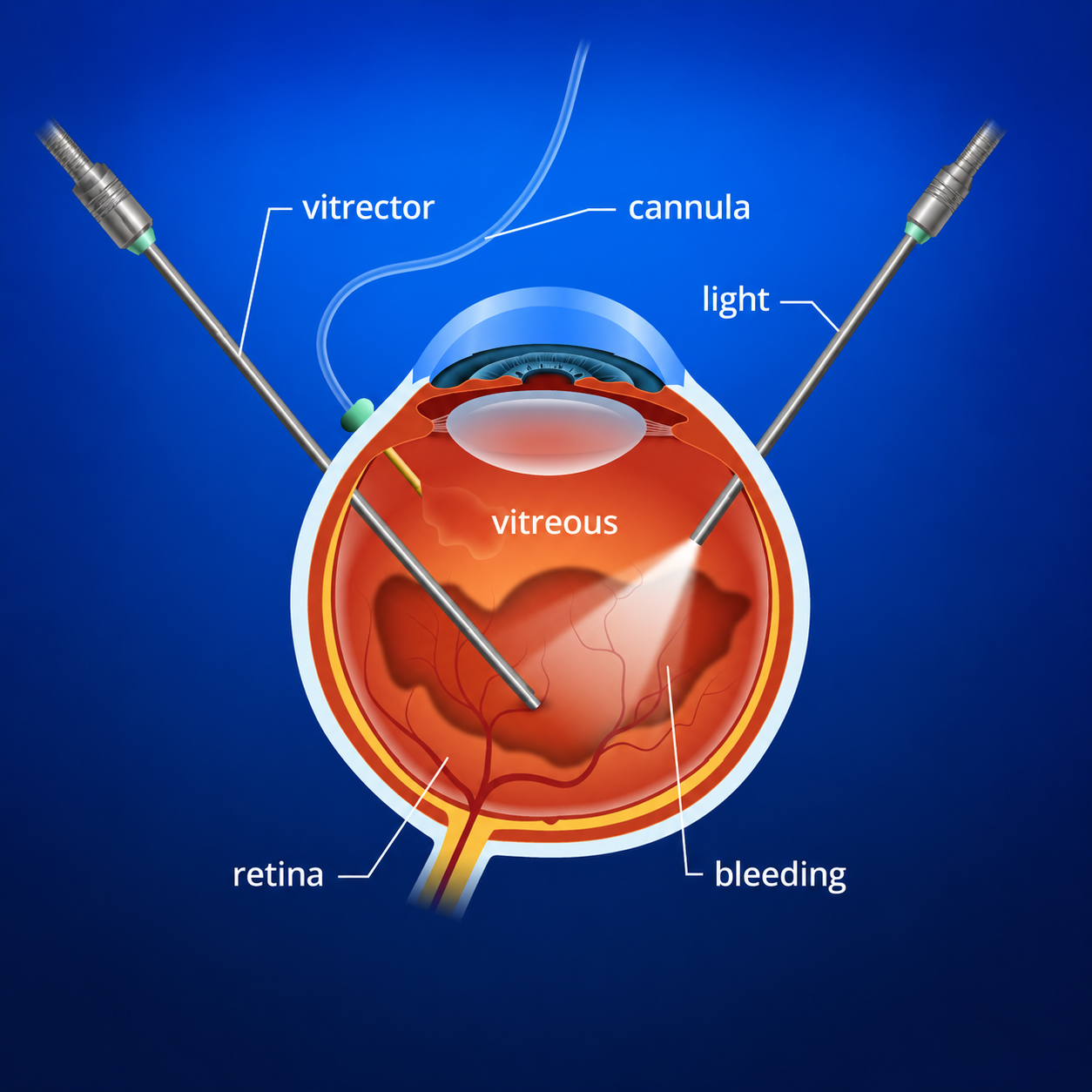 Vitreous Hemorrhage
