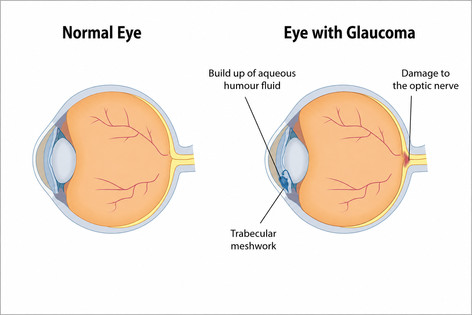 Glaucoma Treatment