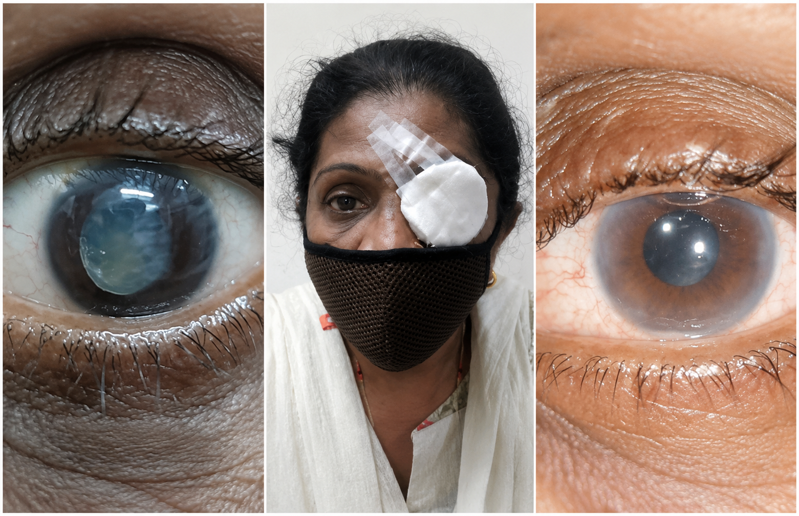 An intraocular lens was successfully implanted in the 55-year-old HIV-positive widow who had a total white cataract in her left eye