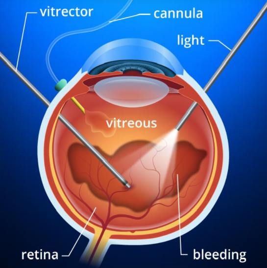 Diabetic Retinopathy
